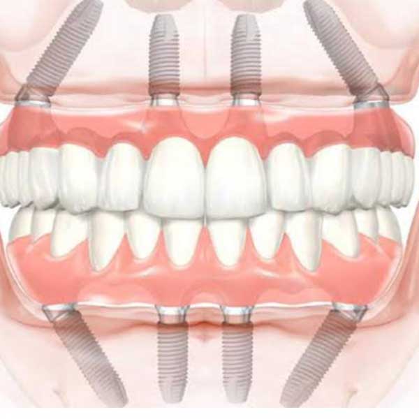 how much is all on 4 dental implants