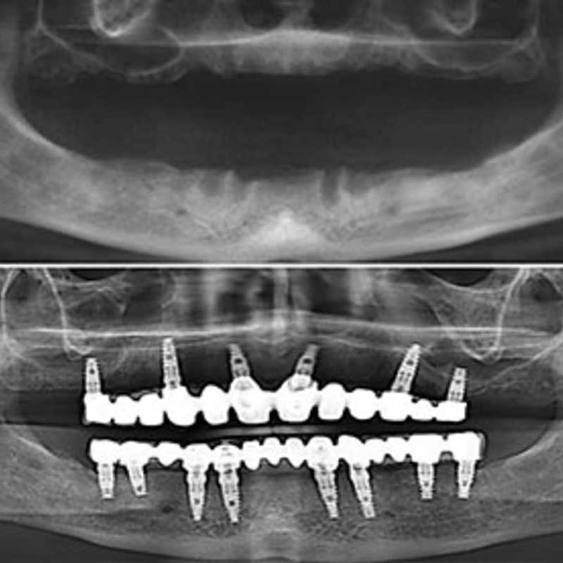 how much do All On 6/8 dental implants cost