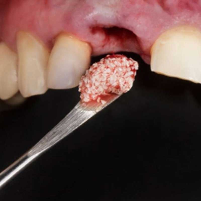 Bone Grafting