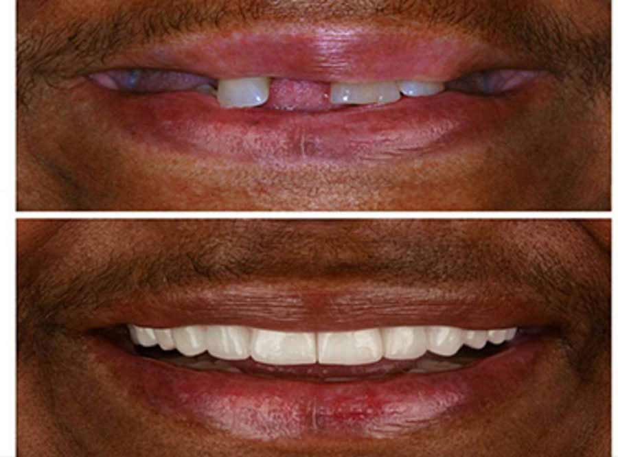 Unattarctive Smile correction in delhi