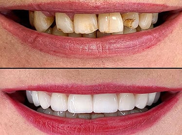 Cosmetic Dentistry treatment package