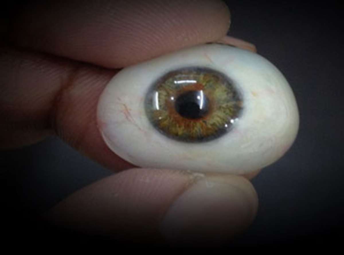 Artificial Eye Prosthesis in India