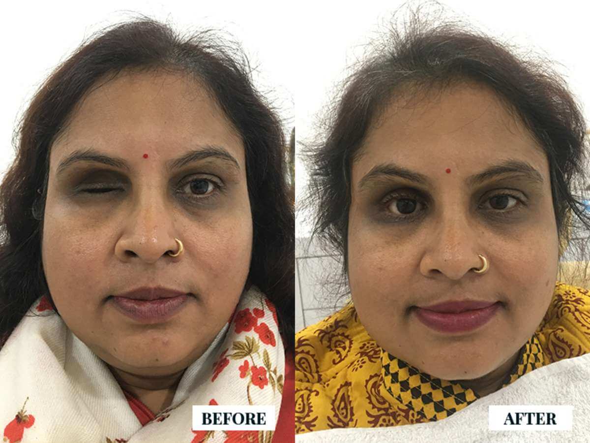 Artificial eye Prosthesis package in india