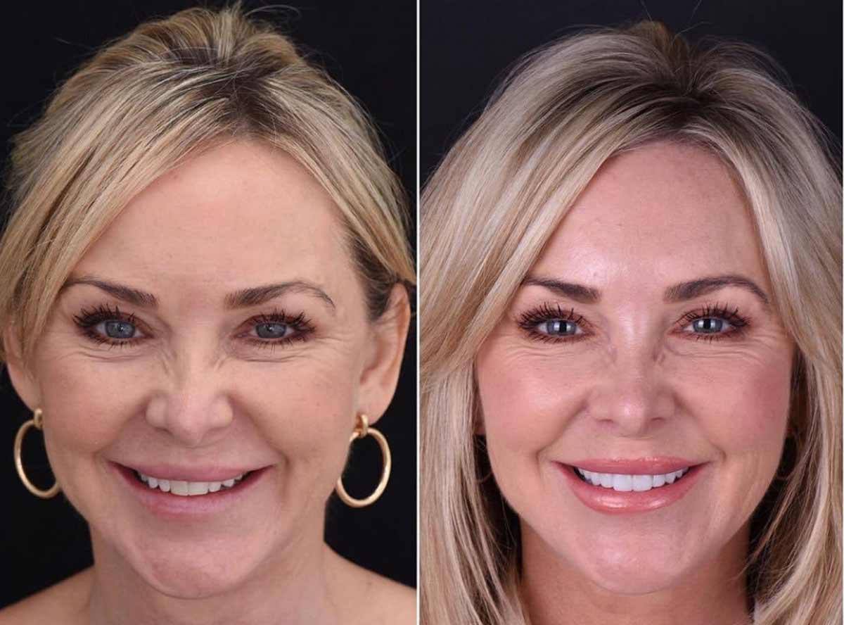 Facial Cosmetic Treatments in India