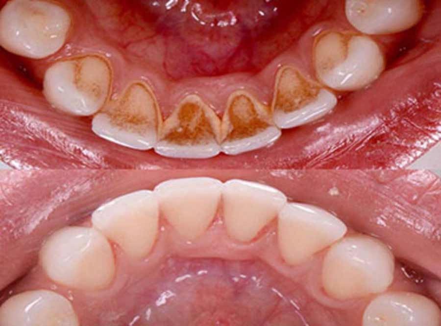 teeth Cleaning & Polishing in south delhi