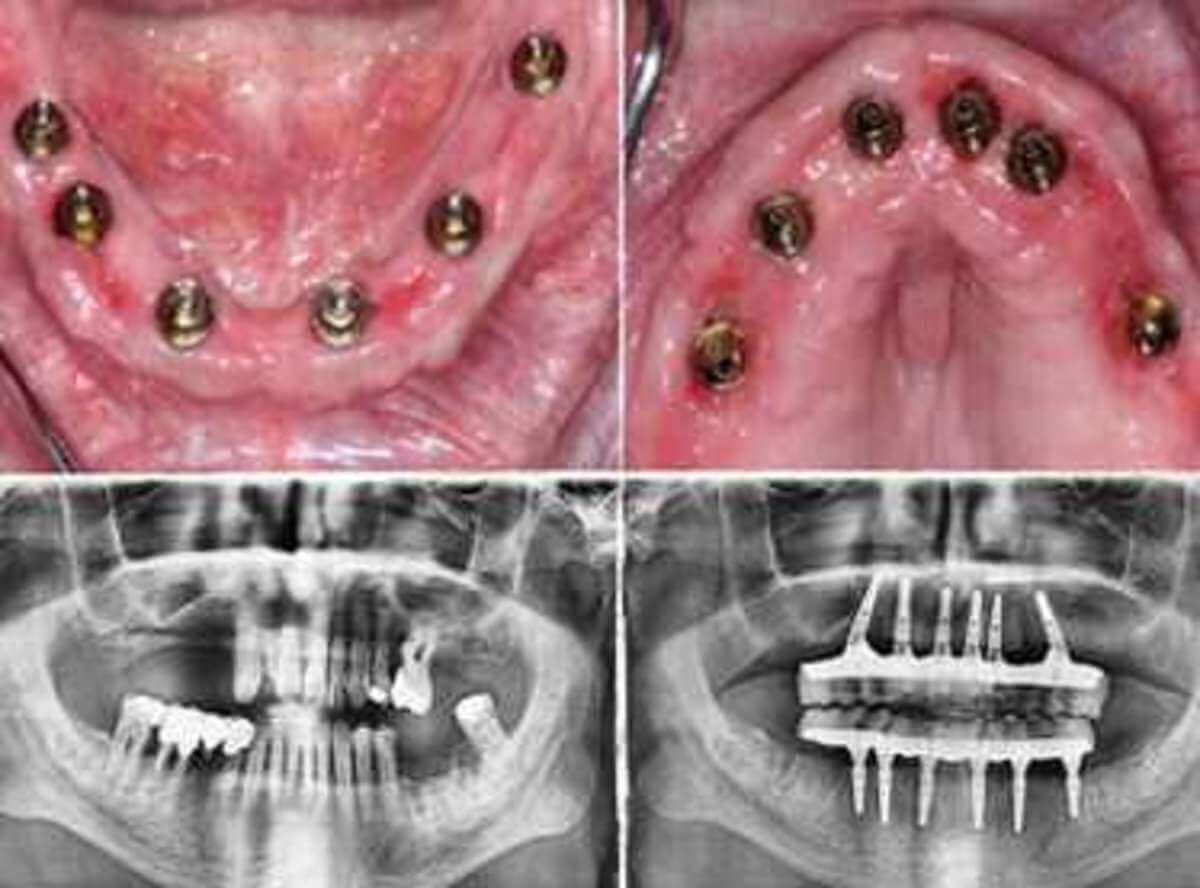 affordable dental implants package