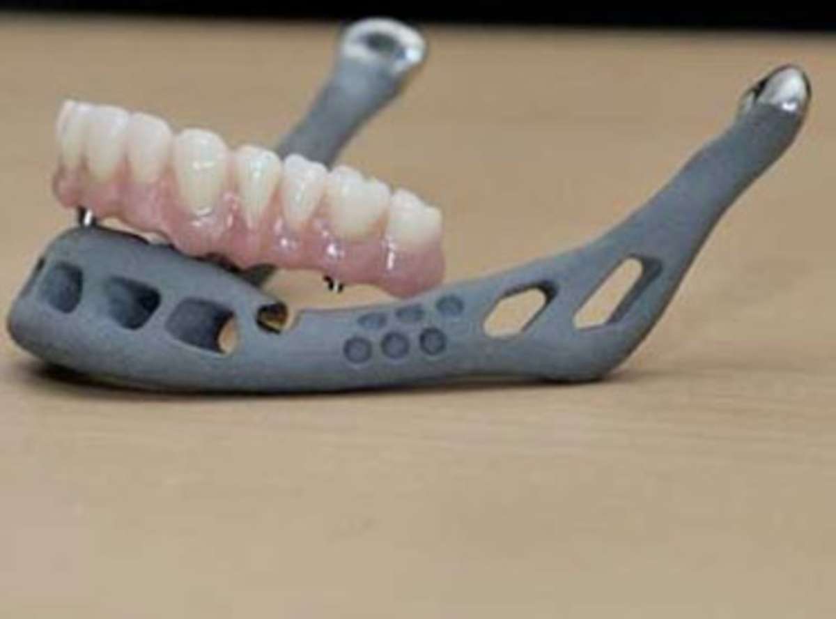 Artificial Tongue/Jaw Reconstruction surgery in india