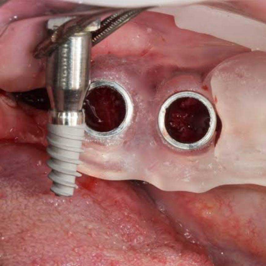 best Keyhole Dental Implants implantologist in india 