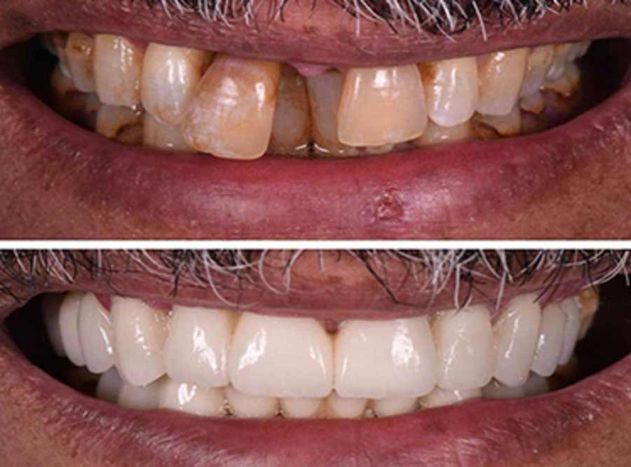 Loose Teeth solution