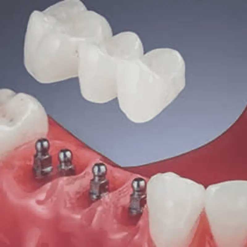 how much do mini implants cost in India