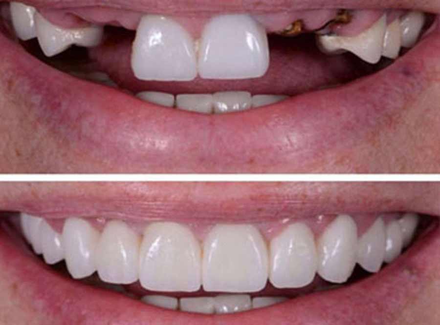 Missing Teeth treatment in india
