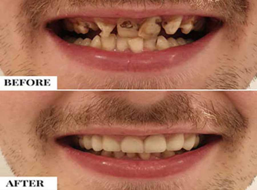 Malaligned teeth/Crooked Teeth treatment in delhi