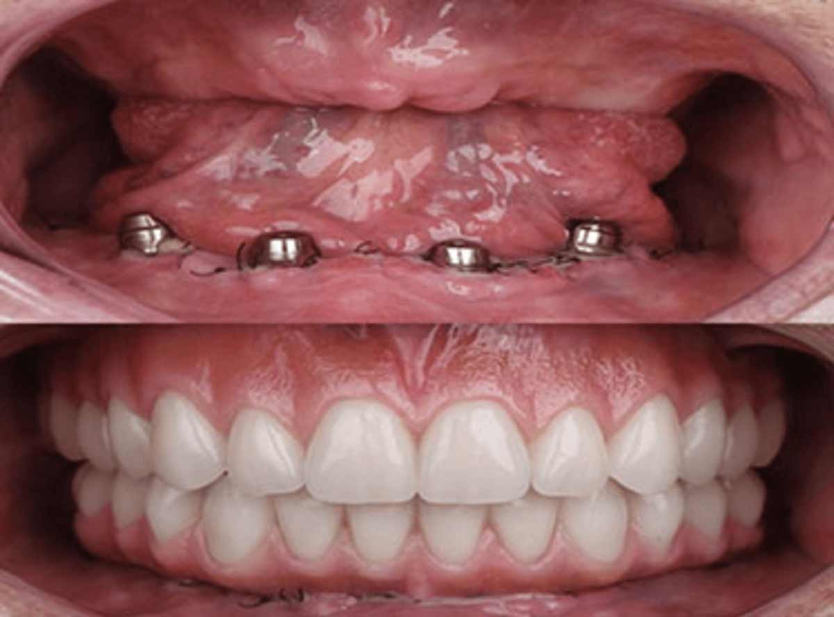 Same Day Dentures placement in nearby