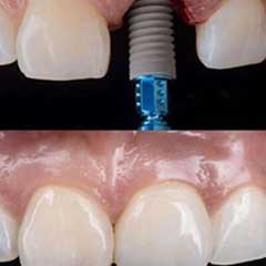 how much does 1 dental implant cost