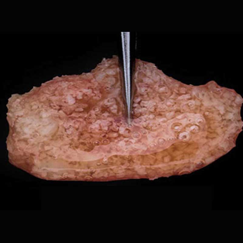 Soft Tissue Grafting surgery