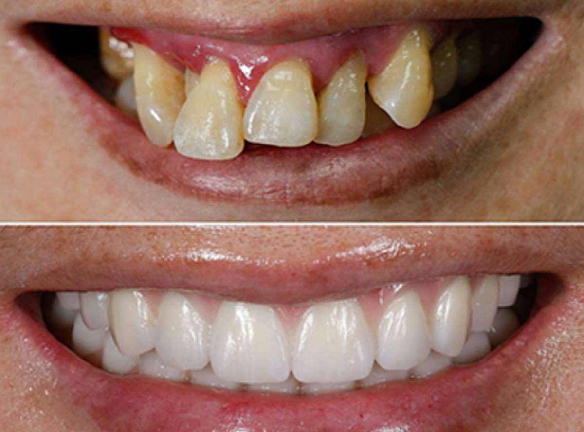Mouth Sores reason and treatment