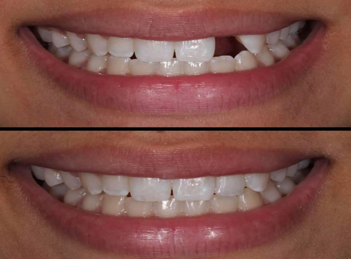 artificial Teeth in an Hour in south delhi
