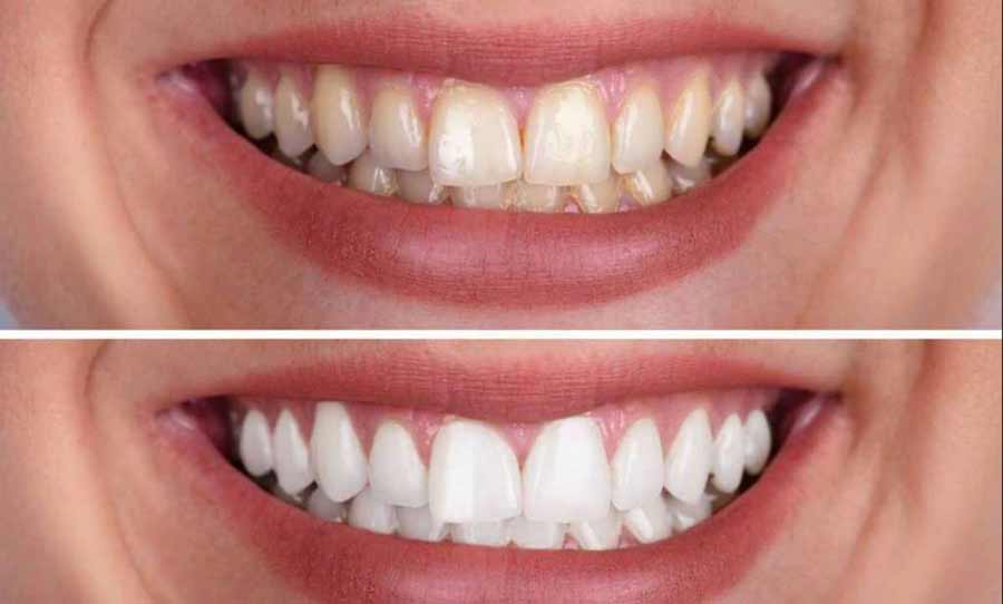 Discolored Teeth treatment in GK 1