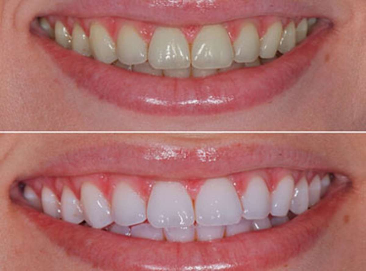 quick teeth whitening nearby