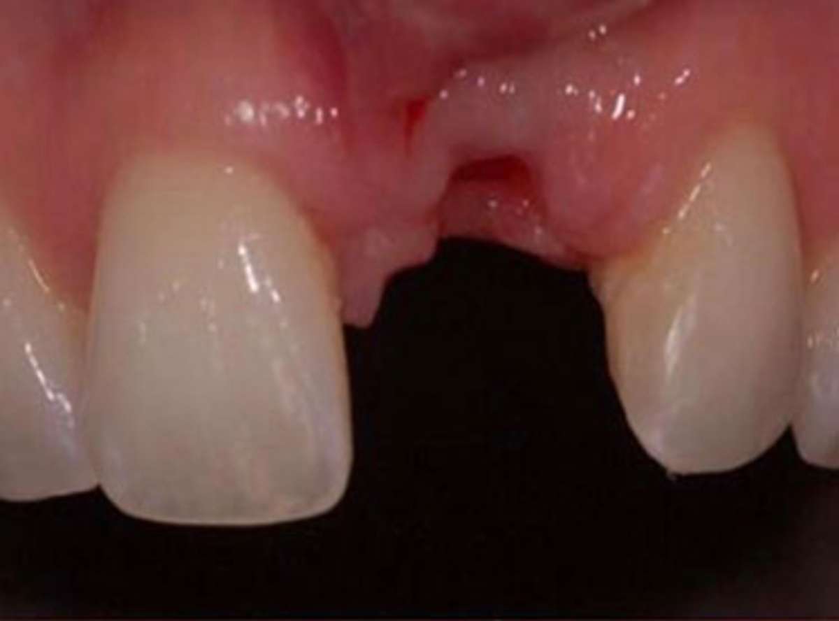 painless Tooth Extractions in delhi