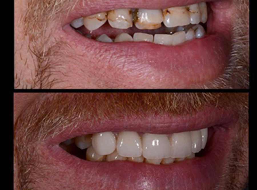 Bruxism in India