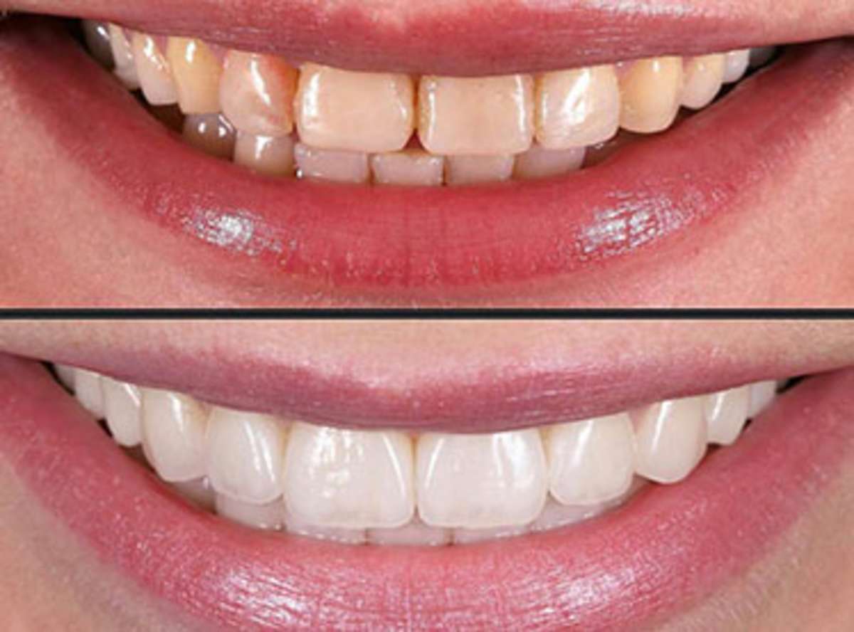 dental Veneers near me