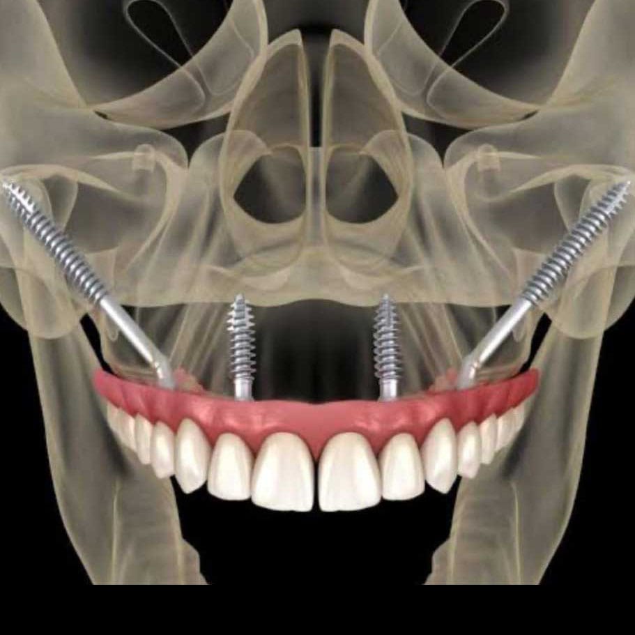 Zygomatic Implants in india